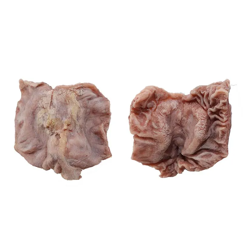 Gastric Cancer Model Gastric Cancer Model